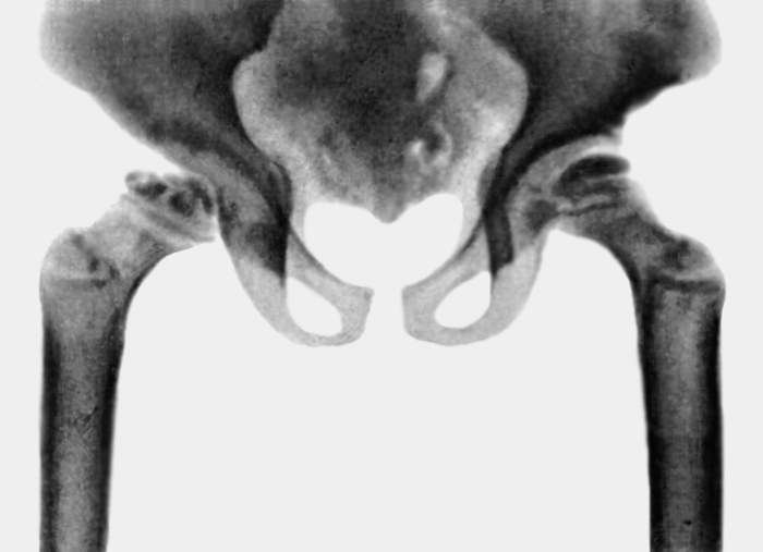 Рис. 8б). Рентгенологические признаки синдрома Марото — Лами — деформация костей таза