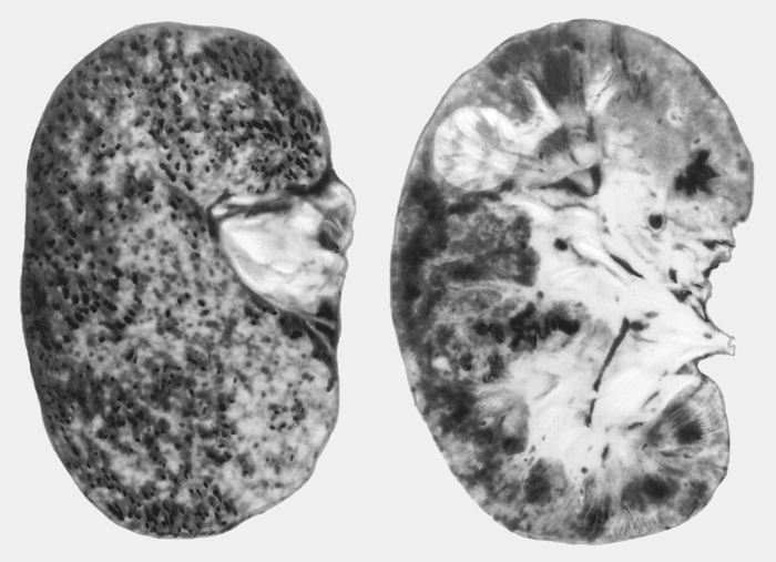 Рис. 4. Макропрепарат почки при злокачественной форме нефросклероза: слева — общий вид (<a href=