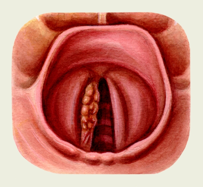 Рис. 5. Ранняя стадия рака голосовой складки справа