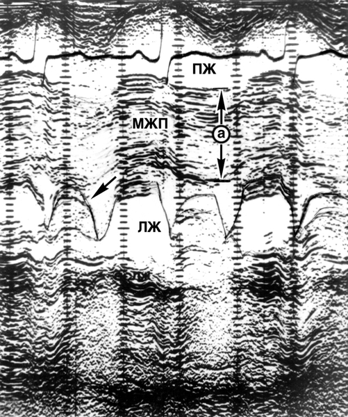 Рис. 11б). В М-режиме эхокардиограмма больного с обструктивной гипертрофической кардиомиопатией (на эхокардиограммах в М-режиме полости сердца — светлые поля, плотные структуры — темные): б — толщина межжелудочковой перегородки на уровне проекции митрального клапана резко увеличена (а = 2,5 см), эхосигналы от створок митрального клапана (видны в полости левого желудочка) в диастолу примыкают к межжелудочковой перегородке (отсутствует митрально-аортальная сепарация), а в систолу определяется патологическое переднее движение передней створки (указано стрелкой)