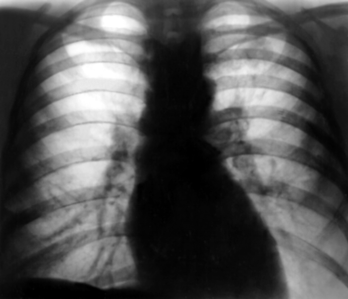 Рис. 12. Рентгенограмма органов грудной клетки в прямой проекции при круглом инфильтрате левого легкого: в верхней доле левого легкого под ключицей определяется слабо интенсивная гомогенная округлая тень с четкими границами