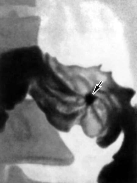 Рис. 1б). Прицельные рентгенограммы (в разных проекциях) луковицы двенадцатиперстной кишки при язвенной болезни: ниша рельефа, или фасная ниша (указана стрелкой), с конвергенцией к ней складок слизистой оболочки