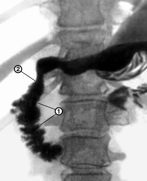 Рис. 13. Рентгенограмма желудка и двенадцатиперстной кишки при раке головки поджелудочной железы: нисходящая часть двенадцатиперстной кишки расширена, имеет неровные контуры (1), снаружи определяется вдавление (2), создаваемое увеличенным желчным пузырем