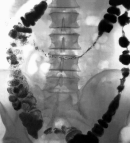 Рис. 3. Рентгенограмма толстой кишки при спастическом запоре через 24 часа после приема бариевой взвеси: видно резкое <a href=