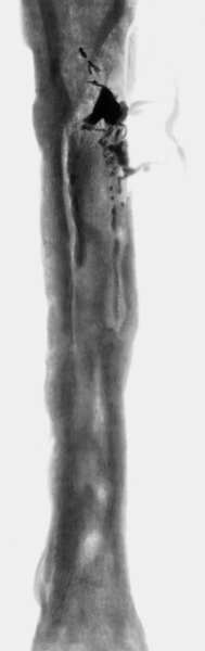 Рис. 11. Рентгенограмма бедренной кости больного с хроническим тотальным остеомиелитом: утолщение и деформация кости, надкостница утолщена, неровная, костномозговой канал не прослеживается, участки остеосклероза чередуются с зонами остеопороза; рентгеноконтрастное вещество через <a href=
