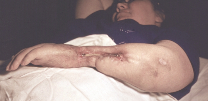 Рис. 9. Больная с хроническим остеомиелитом костей предплечья: резкая деформация нижней трети предплечья, втянутые рубцы с гнойными свищами