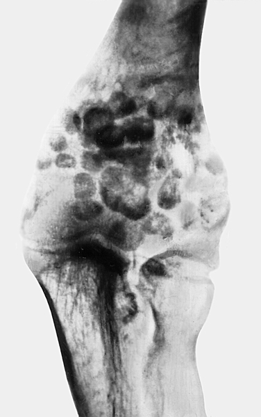 Рис. 12а). Рентгенограмма при хондроматозе локтевого сустава — переднезадняя проекция