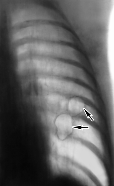 Рис. 2б). Томограмма грудной клетки (прямая проекция) при буллезной эмфиземе легких: в левом легком видны тонкостенные полости овальной формы (указаны стрелками)