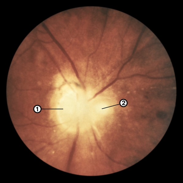 Рис. 23 б). Офтальмоскопическая картина глазного дна при туберкулезном юкстапапиллярном хориоретините в стадии стихающего воспаления: остаточный отек в центре диска зрительного нерва, по краю диска видны старый атрофический хориоретинальный очаг с пигментом по периферии (1) и свежий хориоретинальный очаг (2)