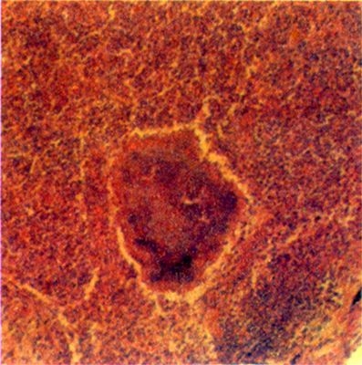 Рис. 2. Микропрепарат легкого при актиномикозе на фоне пневмонии: альвеолы заполнены организующимся экссудатом, в центре поля зрения — друзы актиномицет. <a href=