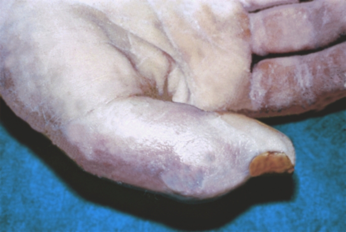 Рис. 11а). Пандактилит I пальца правой кисти: на тыльной поверхности пальца гнойный свищ