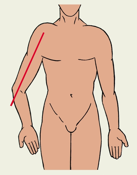 Рис. 6б). Варусная деформации локтевого сустава — угол, образованный осью плеча (обозначен красной линией) и предплечьем открыт кнутри