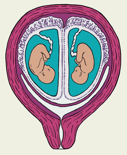 Рис. 2. Схематическое изображение плодов (показано на разрезе), развивающихся в матке из двух яйцеклеток, имплантировавшихся близко друг к другу (двуяйцовая двойня): 1 — плацента, 2 — амнионы, 3 — хорионы, 4 — капсулярная децидуальная оболочка, 5 — париетальная децидуальная оболочка