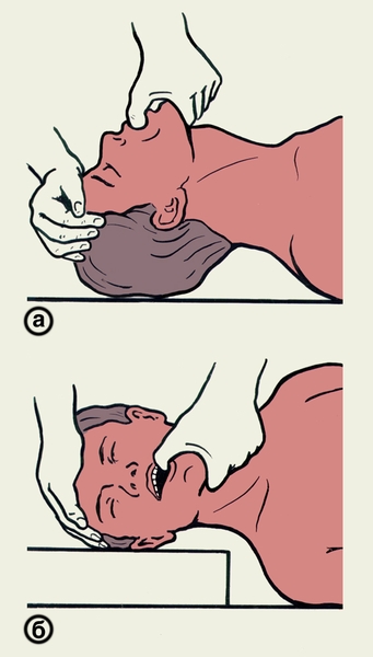 Рис. 3 а,б). Схематическое изображение открывания рта пострадавшего пальцем
