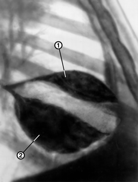 Рис. 6. Рентгенограмма органов грудной клетки больного с правосторонним междолевым плевритом (правая боковая проекция): линзообразные тени выпота в горизонтальной (1) и косой (2) междолевых щелях правого легкого