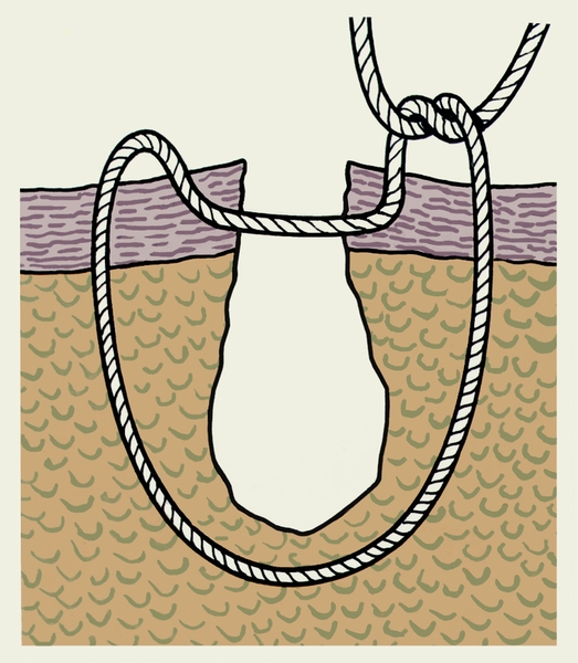 Рис. 6. Схематическое изображение П-образного (петлеобразного) узлового адаптирующего шва по Донати