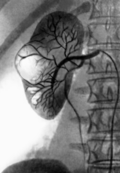 Рис. 8. Селективная почечная артериограмма при солитарной кисте правой почки: в зоне расположения кисты почти полностью отсутствуют сосуды