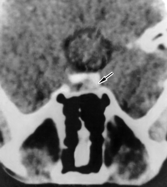 Рис. 2. Компьютерная томограмма области турецкого седла (аксиальная проекция) больного с соматотропиномой (указана стрелкой)