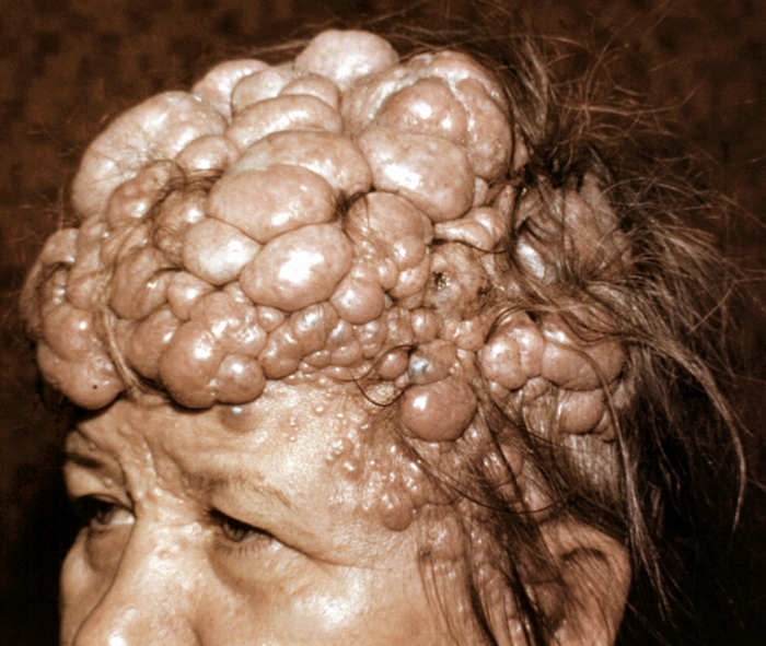 Рис. 4. Цилиндрома: обширное опухолевое разрастание с гладкой поверхностью на коже головы («тюрбанная опухоль»)