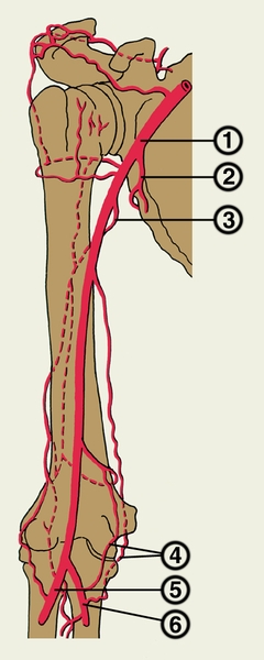 Рис. 4. Схематическое изображение развития коллатерального кровообращения после перевязки плечевой артерии (уровень перевязки указан стрелкой): 1 — плечевая артерия; 2 — подлопаточная артерия; 3 — глубокая артерия плеча; 4 — артериальное сплетение в области локтевого сустава; 5 — лучевая артерия; 6 — локтевая артерия; пунктиром обозначены сосудистые коллатерали
