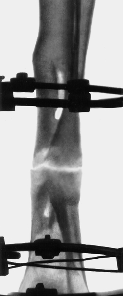 Рис. 21а). Рентгенограмма голени больного с хроническим посттравматическим остеомиелитом: наложен дистракционно-компрессионный аппарат Илизарова, угловое смещение устранено