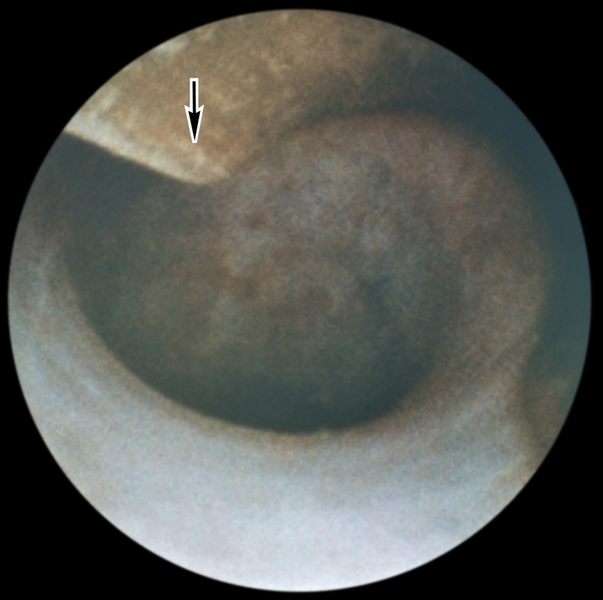 Уретроскопическая картина губчатой части мочеиспускательного канала в норме: в центре поля зрения виден просвет уретры, окруженный неизмененной слизистой оболочкой (стрелкой указан клюв уретроскопа)
