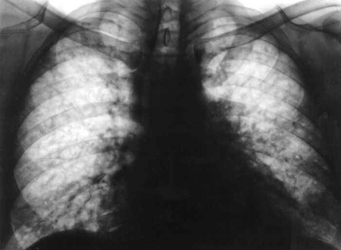 Рентгенограмма грудной клетки больного идиопатическим фиброзирующим альвеолитом (прямая проекция): усиление и сетчатая деформация легочного рисунка