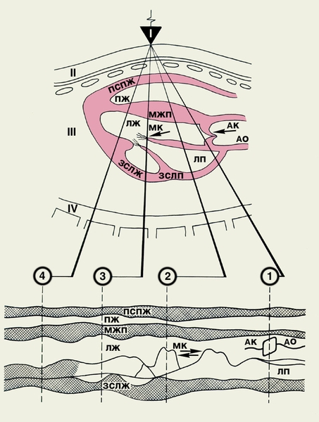 Рис. 3. Схема основных позиций одномерной эхографии структур сердца, расположенных вблизи его основания (позиция 1), в средней трети длины (позиции 2 и 3) и в области верхушки (позиция 4). Во всех позициях отображаются передняя стенка правого желудочка и его полость, а в позициях 3 и 4 — межжелудочковая перегородка, полость левого желудочка и его задняя стенка, в позиции 1 визуализируются аорта, аортальный клапан (АК), полость левого предсердия и его задняя стенка (ЗСЛП), в позиции 2 — левое предсердие и митральный клапан. Дополнительные обозначения: I — генератор УЗ и приемник отраженных сигналов; II — передняя грудная стенка; III — сердце; IV — задняя грудная стенка