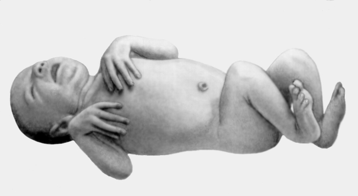 Рис. 1. Новорожденный с синдромом Марфана: арахнодактилия кистей и стоп
