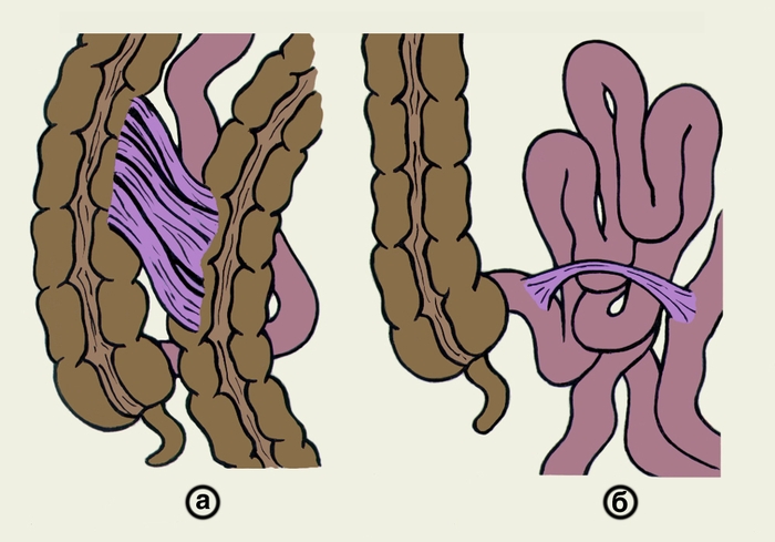Рис. 7. Схематическое изображение плоскостных (а) и тяжевых (б) внутрибрюшинных спаек