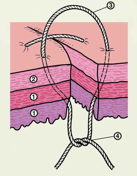 Рис. 4. Схематическое изображение вворачивающего шва по Пирогову — Матешуку, наложенного на стенку кишки: 1 — <a href=