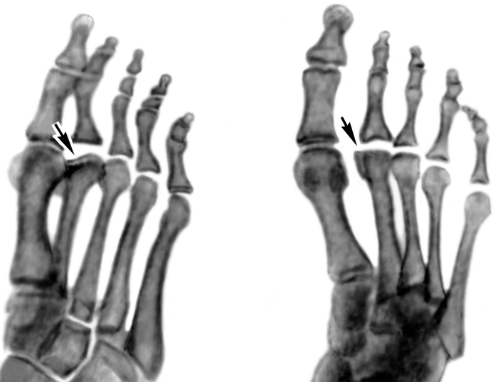 Болезнь келлера стопы. Остеохондропатия ладьевидной кости стопы. Остеохондропатия головки 1 плюсневой кости. Остеохондропатия ладьевидной кости Келлер 1. Остеохондропатия 2 плюсневой кости.
