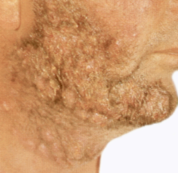 Рис. 4а. Инфильтративно-нагноительные очаги в области бороды при паразитарном сикозе