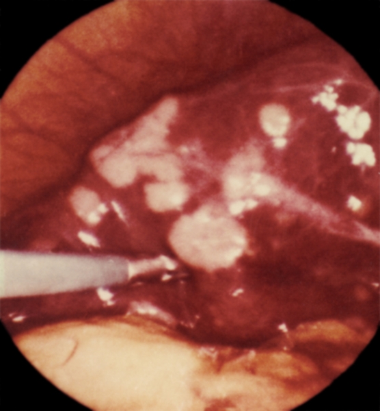Рис. 15. Лапароскопическая картина первичного рака печени при локализации опухоли в левой доле