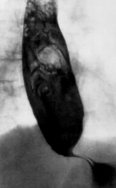 Рис. е). Рентгенологическая картина при различных заболеваниях и поражениях пищевода, сопровождающихся дисфагией: резкое расширение пищевода при ахалазии
