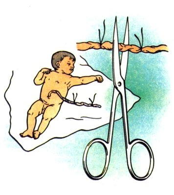 Перевязка и пересечение пуповины у новорожденного