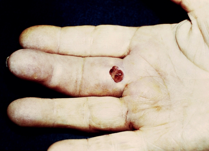 Рис. 10. Сухожильный панариций III пальца с некрозом сухожилия сгибателя: на ладонной поверхности пальца виден гнойный свищ