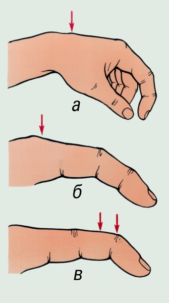 Рис. 1. Характерное положение пальцев при повреждении сухожилий мышц-разгибателей на различном уровне: а — на уровне предплечья и кисти; б — на уровне основной фаланги; в — на уровне средней и ногтевой фаланг. Стрелками указано место повреждения