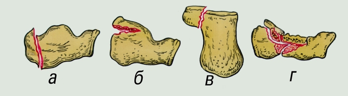 Рис. 1. Переломы пяточной кости: а — вертикальный перелом пяточного бугра; б — горизонтальный клювовидный перелом пяточного бугра; в — изолированный перелом отростка; г — компрессионный перелом