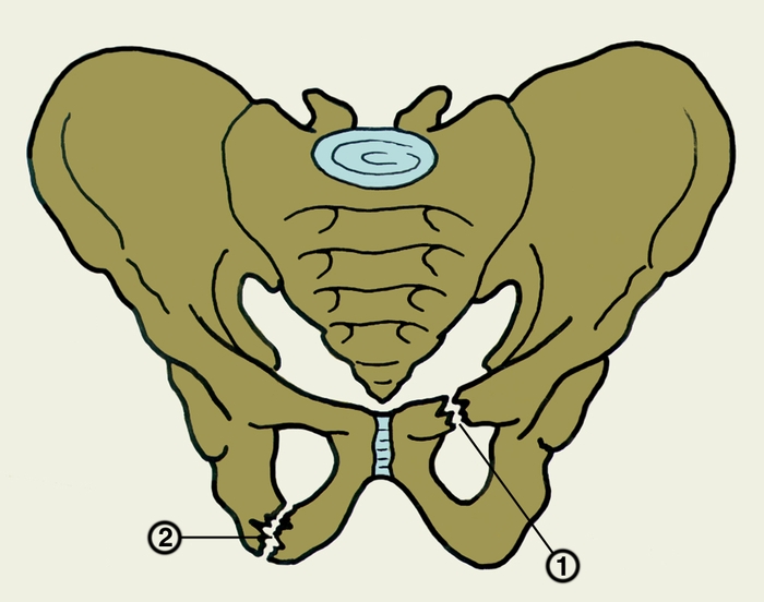Рис. 5. Схематическое изображение диагонального перелома лонной (1) и седалищной (2) костей