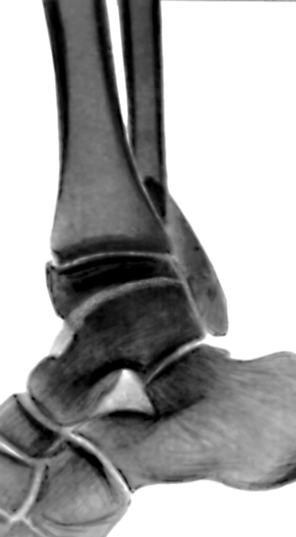 Рис. 3в). Рентгенограмма голеностопных суставов при переломах образующих их костей у детей: остеоэпифизеолиз дистального конца малоберцовой кости (боковая проекция)