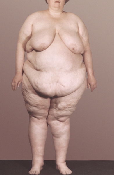 Рис. 2а). Больная гипофизарным ожирением с преимущественным отложением жира на передней брюшной стенке, свисающей в виде фартука