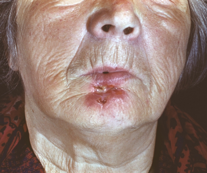 Рис. 15. Язвенная базалиома (ulcus rodens): глубокопроникающая язва с неровными границами на коже подбородка