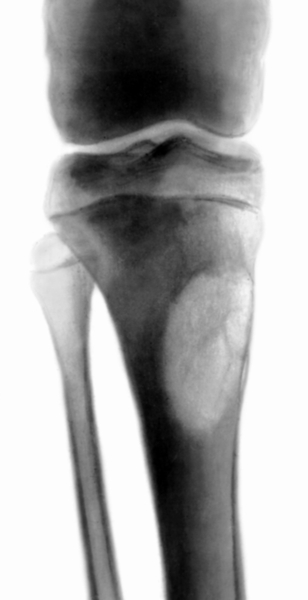 Рис. 4г). Динамика развития аневризмальной кисты кости: у того же больного через 4 года (киста в фазе восстановления) на месте полости видны перестраивающаяся кость и остаточные мелкие кисты