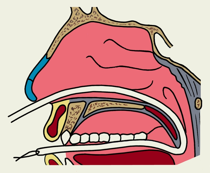 Рис. 2а). Схематическое изображение этапов задней тампонады полости носа: резиновый катетер проводят по дну полости носа в носоглотку и, захватив его корнцангом, выводят через рот