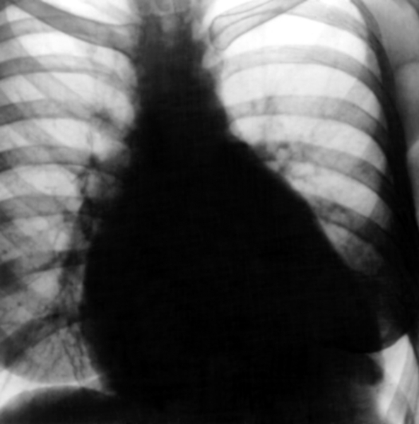 Рис. 22. Рентгенограмма грудной клетки больного с сочетанным митральным пороком в комбинации с трикуспидальной недостаточностью: выбухание третьей дуги и пульмонального конуса, расширение поперечника тени сердца, в том числе значительно вправо