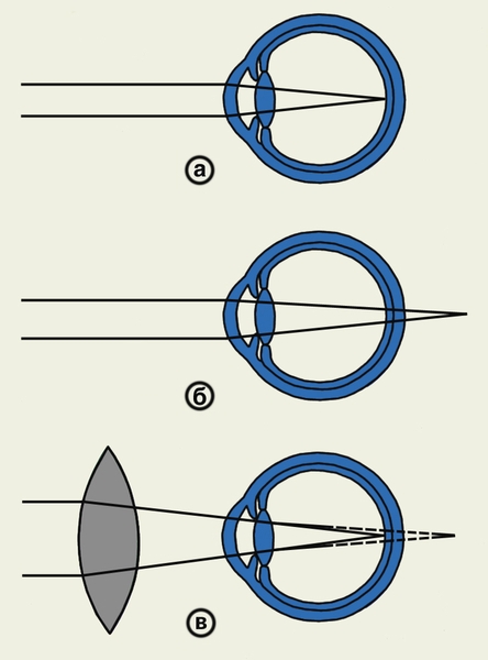 Схематическое изображение хода лучей в эмметропическом (а), дальнозорком без коррекции (б) и дальнозорком с коррекцией собирательной линзой (в) глазу: а — лучи света, идущие <a href=