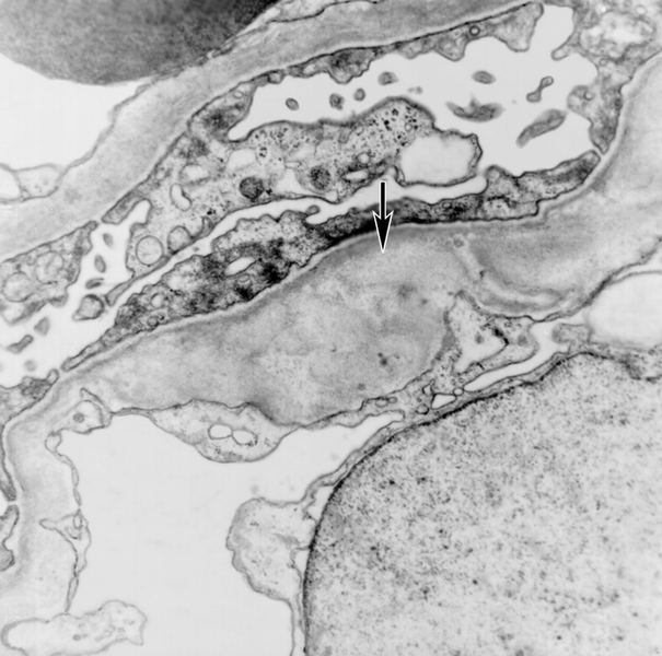 Рис. 6а). Электронограмма почки при фокальном сегментарном гломерулярном гиалинозе — неровные контуры эндотелиальной поверхности базальной мембраны (указано стрелкой) гломерулярных капилляров — начальные изменения; ×15000