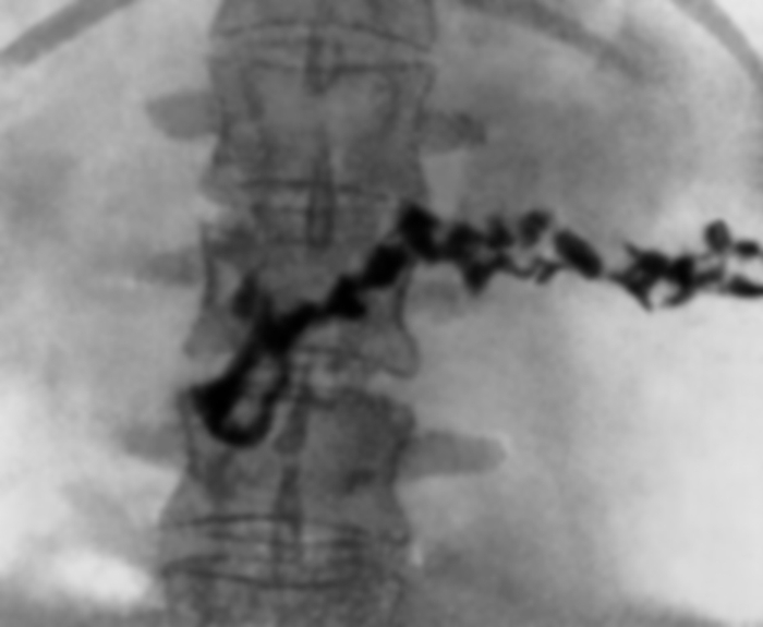 Рис. 2. Рентгенограмма области поджелудочной железы при хроническом панкреатите: определяются множественные камни по ходу панкреатического протока