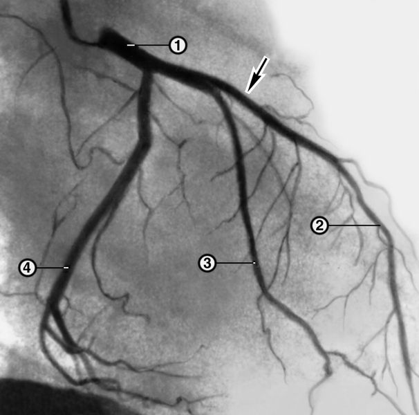 Рис. 2б). Ангиограмма ствола (1) и ветвей левой коронарной артерии (2 — передняя межжелудочковая артерия, 3 — диагональная артерия, 4 — огибающая артерия) больного со стенокардией напряжения: непосредственно после чрескожной баллонной ангиопластики передней межжелудочковой артерии (стрелкой указано место бывшего стеноза артерии, где отмечено полное восстановление ее просвета)